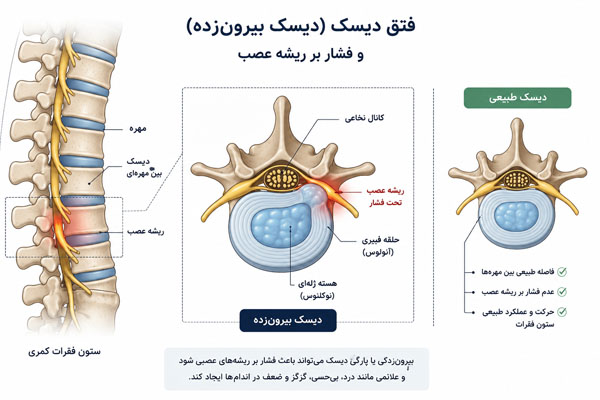تصویر شماتیک فتق دیسک و فشار بر ریشه عصب در ستون فقرات